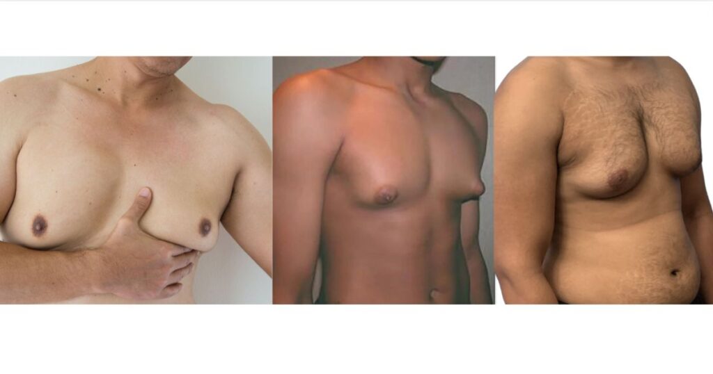 Gyno vs fat – a realistic visual comparison between true gynecomastia and regular chest fat