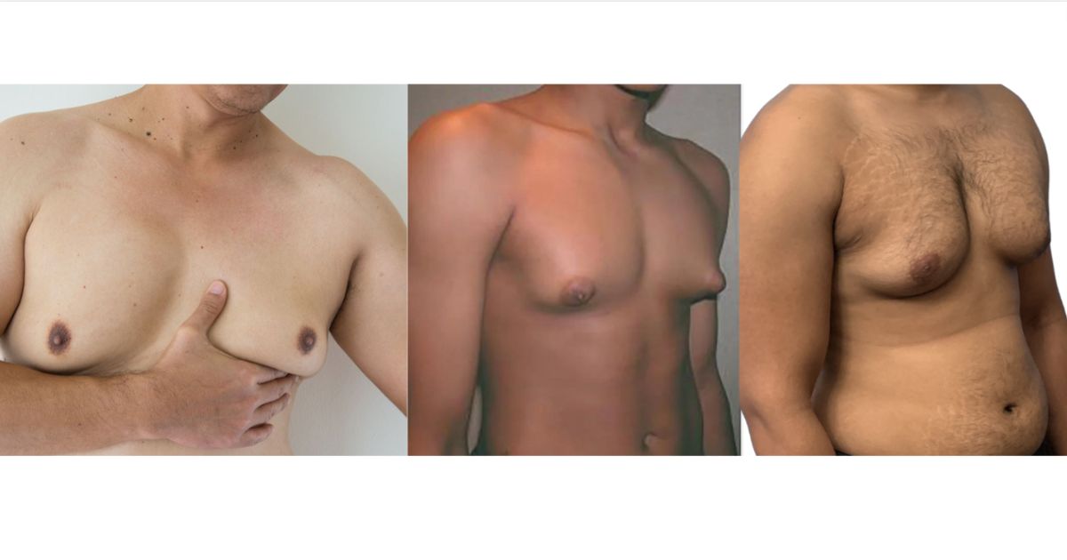 Gyno vs fat – a realistic visual comparison between true gynecomastia and regular chest fat